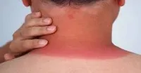 20 روش درمان خانگی آفتاب سوختگی؛ از حمام شیر تا ماسک‌های خانگی