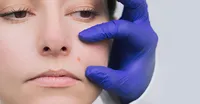مراقبت‌‎های بعد از برداشت خال؛ چطور جای زخم را به حداقل برسانیم؟
