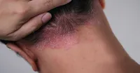 معرفی بهترین شامپو پسوریازیس برای پاکسازی سر از پوسته‌ها