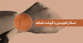 اسکار کلوئیدی یا گوشت اضافه؛ علائم و راه‌های درمان