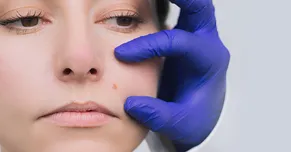 مراقبت‌‎های بعد از برداشت خال؛ چطور جای زخم را به حداقل برسانیم؟