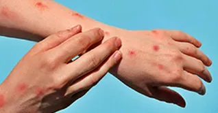 😷 سازمان جهانی بهداشت اعلام کرد که ام پاکس «کووید جدید» نیست!