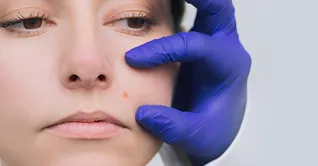 مراقبت‌‎های بعد از برداشت خال؛ چطور جای زخم را به حداقل برسانیم؟