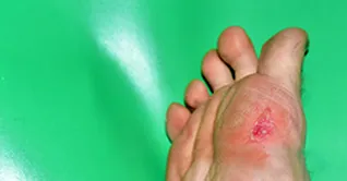 زخم پای دیابتی چیست و چگونه درمان می‌شود؟