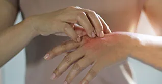 چگونه از پوست خود در برابر پسوریازیس محافظت کنیم؟