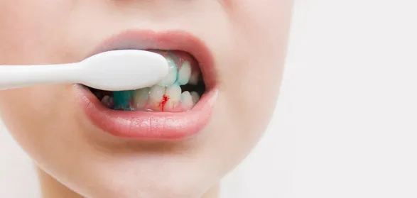 دلیل خونریزی لثه هنگام مسواک زدن چیست؟