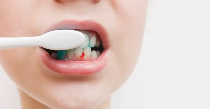 دلیل خونریزی لثه هنگام مسواک زدن چیست؟