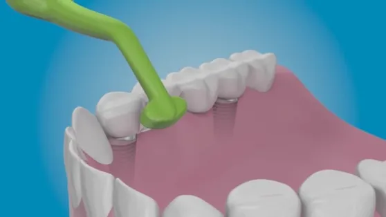 بهترین مسواک مخصوص ایمپلنت در بازار چیست؟