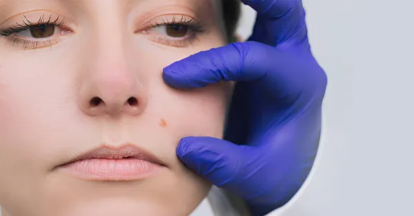 مراقبت‌‎های بعد از برداشت خال؛ چطور جای زخم را به حداقل برسانیم؟